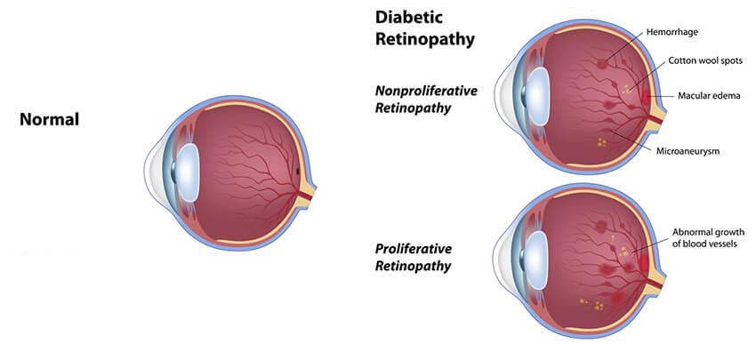 Chart showing a normal eye vs one with diabetic retinopathy