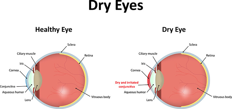 Chart showing a healthy eye compared to one with dry eyes