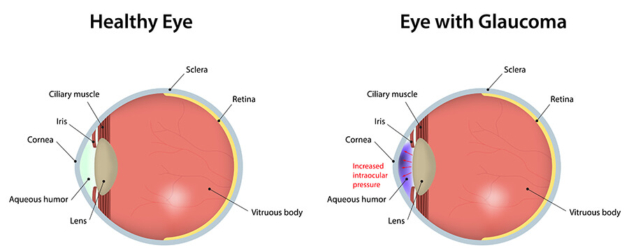 Chart showing a normal eye vs one with glaucoma