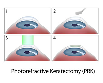 Chart showing PRK procedure